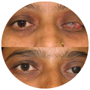 Oculoplasty Patient